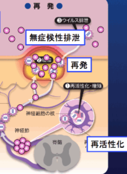 ヘルペス再発