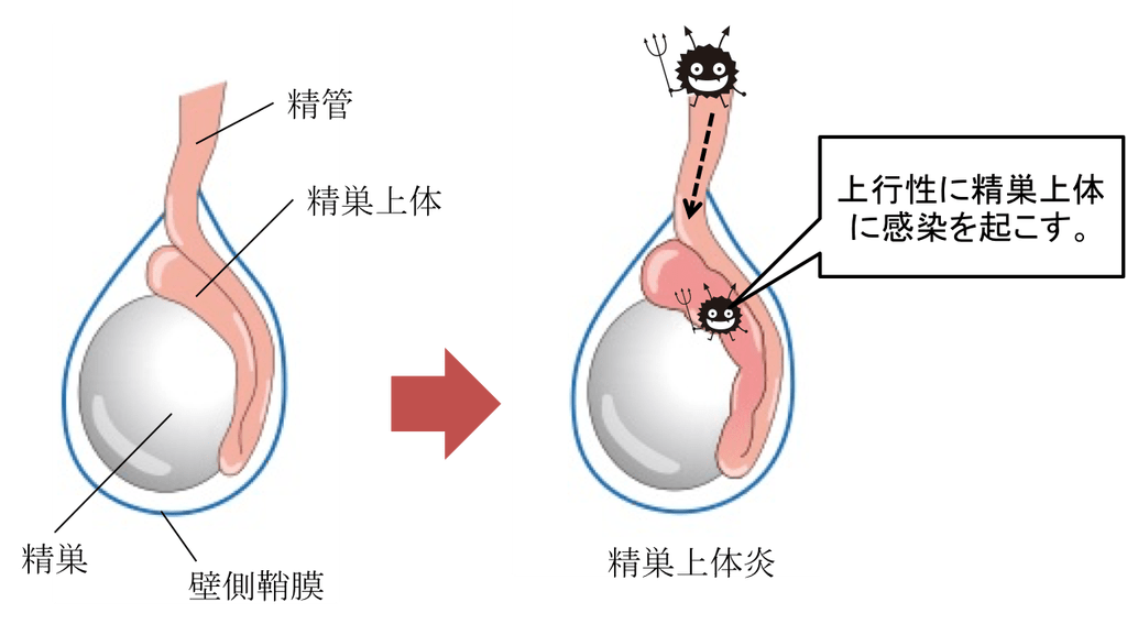 Epididymitis-figure