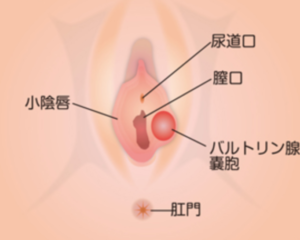 外陰部の片方が腫れて痛いです 性病と関係がありますか